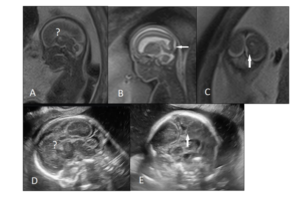 Figure 1. An 18 weeks fetus with mild ventriculomegaly and suspected corpus callosum abnormality was referred for fetal MRI. A, B, C) T2-weighted MRI images showed complete agenesis of corpus callosum and unilateral abnormal sulcation(arrow) in occipital horn. D, E) Transvaginal neurosonography found similar findings.